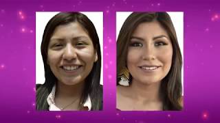 BLEFAROPLASTIA  RINOPLASTIA  Ciudad Belleza  Cirugía Plástica Martinez [upl. by Ritz]