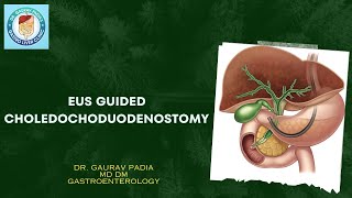 Endoscopic Ultrasound Guided Choledochoduodenostomy  PeriAmpullary Carcinoma  EUSBD [upl. by Cyrie878]