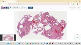 2024 09 26 Aneurysmal Bone Cyst [upl. by Eleanor]