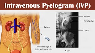 Intravenous pyelogram IVP [upl. by Ecallaw]