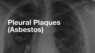 AsbestosRelated Pleural Plaques [upl. by Nnylhsa685]