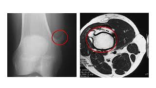 Bone Tumors 3  Chondrogenic Tumors [upl. by Tullus]