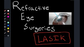 LASIK Eye Surgery  A Basic Overview [upl. by Arob]