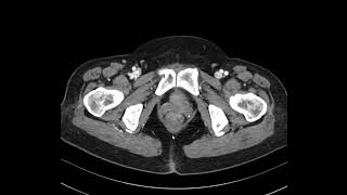 GB adenomyomatosis 2 [upl. by Ches910]