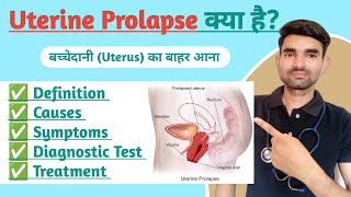 Uterine Prolapse in Hindi  Causes Symptoms And Treatment of Uterine Prolapse [upl. by Sugar]