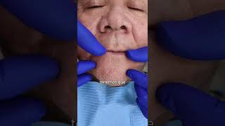 🦷 Implantes en maxilar superior e inferior para una sonrisa renovada ✨ implantesdentales shorts [upl. by Lowis442]