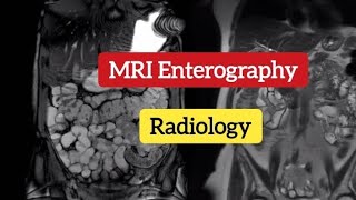 MR Enterography  Small bowel disorde  MRI imaging Radiology [upl. by Evers898]