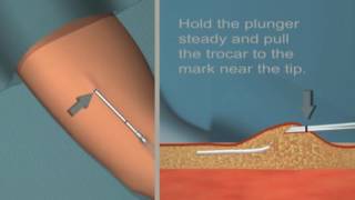 Jadelle insertion and removal Tutorial [upl. by Ynwat374]