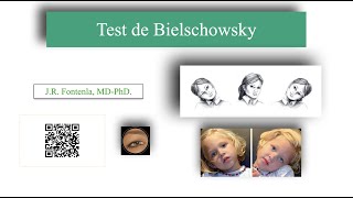 Test de Bielschowsky [upl. by Nonnah]