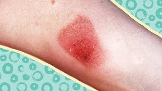 How to Treat Cellulitis [upl. by Means637]