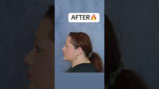 INSANE CHIN LIPO RESULTS 🔥 chinlipo glowup beforeandafter plasticsurgery chinliposuction [upl. by Vey59]