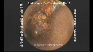 Embolization of earwax in the development of abnormal external auditory canal 20241202 [upl. by Jean-Claude]