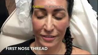 PDOTHREAD LIFT PROCEDURE BY MEDiTHREAD  Nose Lift [upl. by Atonsah]