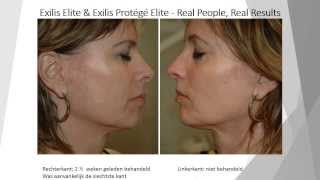 Resultaten Exilis Elite [upl. by Dewie]