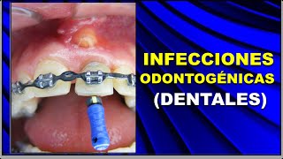 INFECCIONES ODONTOGÉNICAS O DENTALES EVOLUCIÓN Y DIAGNÓSTICO [upl. by Myrtice]