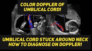 Umlical cord around neck  ultrasound diagnosis [upl. by Natsirt]