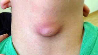 Inflamed Thyroglossal Cyst [upl. by Suirauqram660]