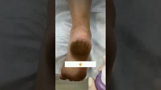 👠Get Rid Of Cracked HeelsRepair Cracked Heels In 1Day cracked heels feetcare youtubeshorts [upl. by Ynaffi]