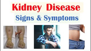 Kidney Renal Disease Signs amp Symptoms ex Peripheral Edema Fatigue Itchiness [upl. by Giddings]