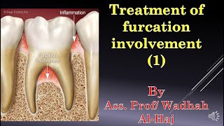 45Periodontal surgery14 Furcation involvement1Dr Wadhah Periodontology lecturesد وضاح الحاج [upl. by Centonze]