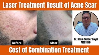 Laser Treatment Result of Acne Scar Treatment  Cost of Combination Treatment [upl. by Coniah]