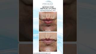 Treatments for Smokers Lines Vertical Lip Lines botox [upl. by Bright]