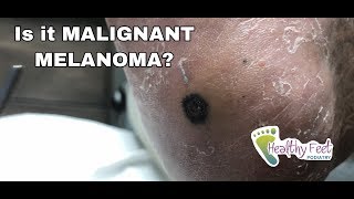 Is it Malignant Melanoma [upl. by Chisholm]