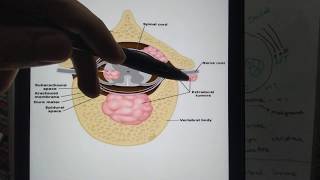 Spinal cord tumors Differences between Intra and Extramedullary lesions [upl. by Iadam588]