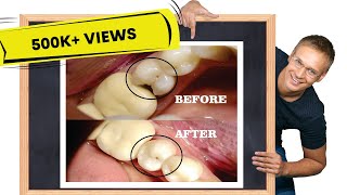 Class II cavity restoration  STEPBYSTEP [upl. by Hnao]