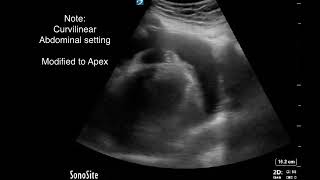 POCUS guided Pericardiocentesis An Intuitive Approach [upl. by Ettedualc]