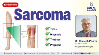 Sarcoma Cancer  Types Diagnosis Treatment amp Prognosis  sarcomatreatment [upl. by Aneekal416]