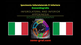 Ecocardiografia  Ipocinesia Inferolaterale E Inferiore [upl. by Eelram32]