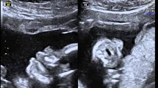 Echographie dun foetus qui tète in utero [upl. by Gyasi]