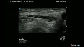 Nervus femoralis block case I Ultrasound Practical demo technique Regional Anesthesia Femur fracture [upl. by Ajiat]