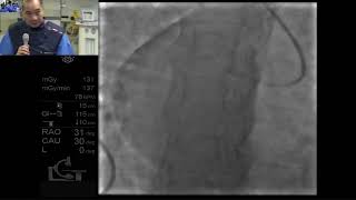 A case of heavily calcified LAD ostial and RCA stenosis Mirror Image Dextrocardia [upl. by Leese477]