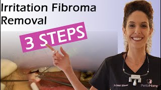 Irritation Fibroma Removal in 3 Steps [upl. by Canale]