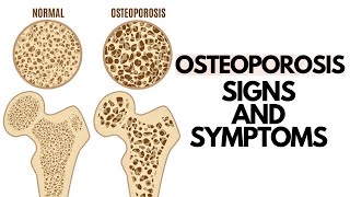 OSTEOPOROSIS Early Symptoms Causes Diet Exercise Prevention and Treatment [upl. by Eetse]