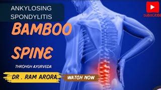 Ankylosing spondylitis Treatment  Bamboo spine treatment  Dr Ram Arora  Through Ayurveda [upl. by Yrellam389]