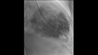 HAKIMVISTA MIOCARDIOPATIA DILATADA VENTRICULOGRAMA CON TROMBO INTRAVENTRICULAR [upl. by Edlin]