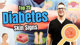 What are the symptoms of type 2 diabetes Early Skin Signs [upl. by Herbert315]