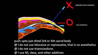 caudal block to decrease painful injection [upl. by Baniaz]