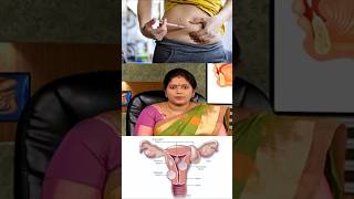 Fibroid கட்டி வர முக்கிய காரணம் இதுதான் 😳 [upl. by Sigfried983]