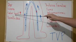 Trombose venosa profunda TVP [upl. by Navonod]