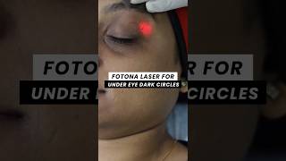 Fotona Laser for Under eye Dark Circles  ClearSkin Pune [upl. by Rammus951]