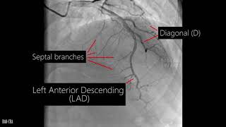 Coronary artery anatomy  Coronary angiogram [upl. by Sancho]