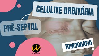 CELULITE ORBITÁRIA PRÉSEPTAL na Tomografia de Face [upl. by Leandre]