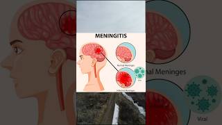 Meningitismedicine healthtips mbbs physiologyhealth healthcaresymptoms treatmentmeningitis [upl. by Adallard]