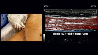 Transversus Abdominis Plane TAP Block  UltrasoundGuided Demonstration [upl. by Vladamar810]