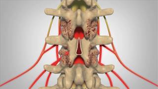 Laminectomy  Patient Education [upl. by Jaime959]