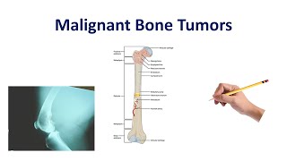 Malignant Bone Tumors  USMLE COMLEX NCLEX [upl. by Nnorahs631]